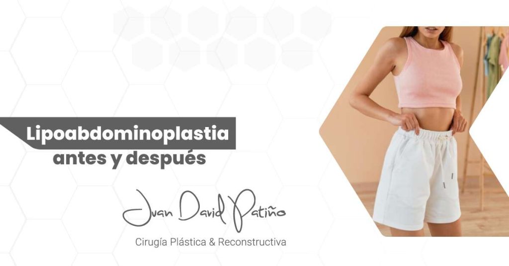 Lipoabdominoplastia en Medellín - Dr. Juan David Patiño - Cirujano Plástico en Medellín