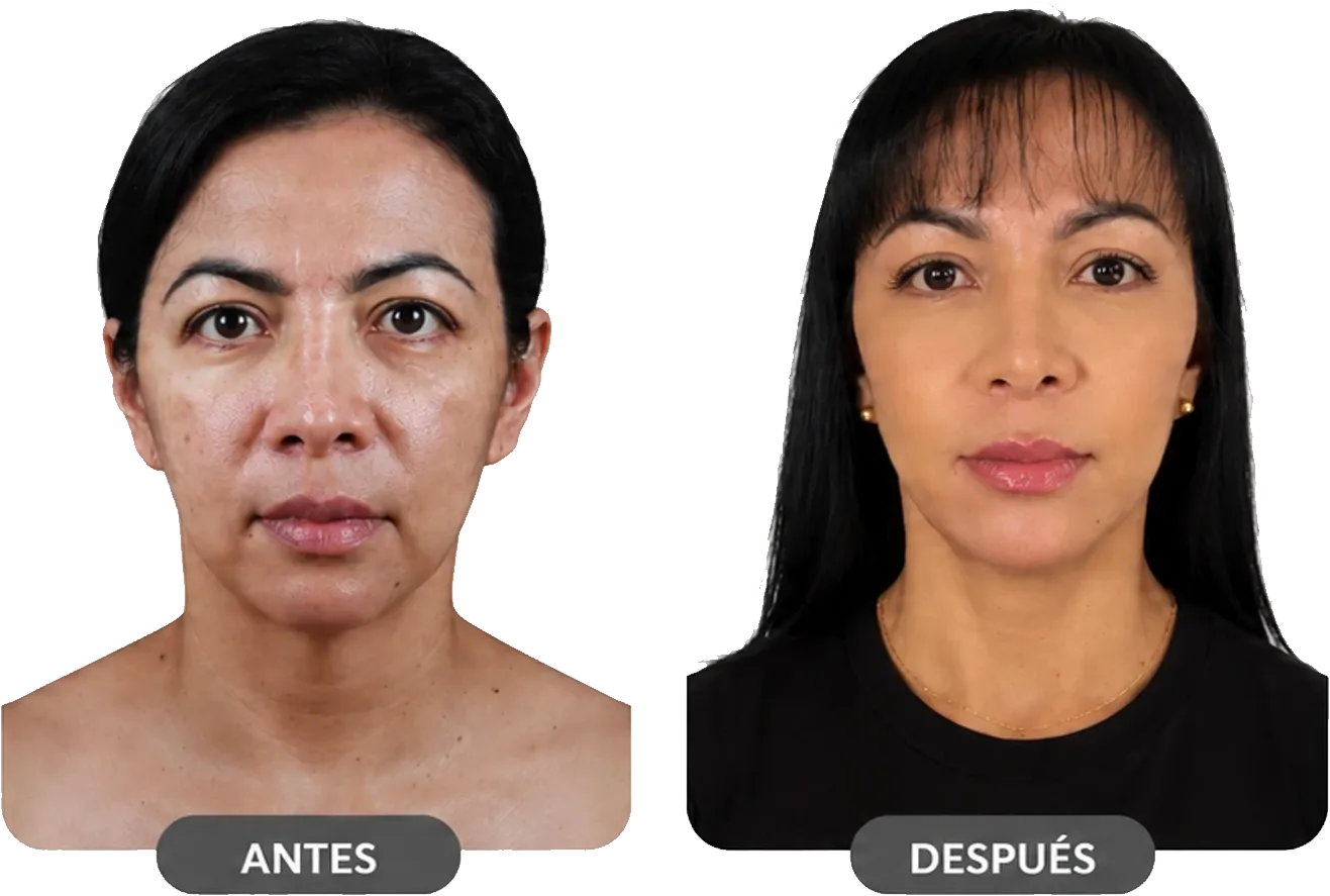 Antes y después de lifting facial endoscópico realizado por el Dr. Juan David Patiño