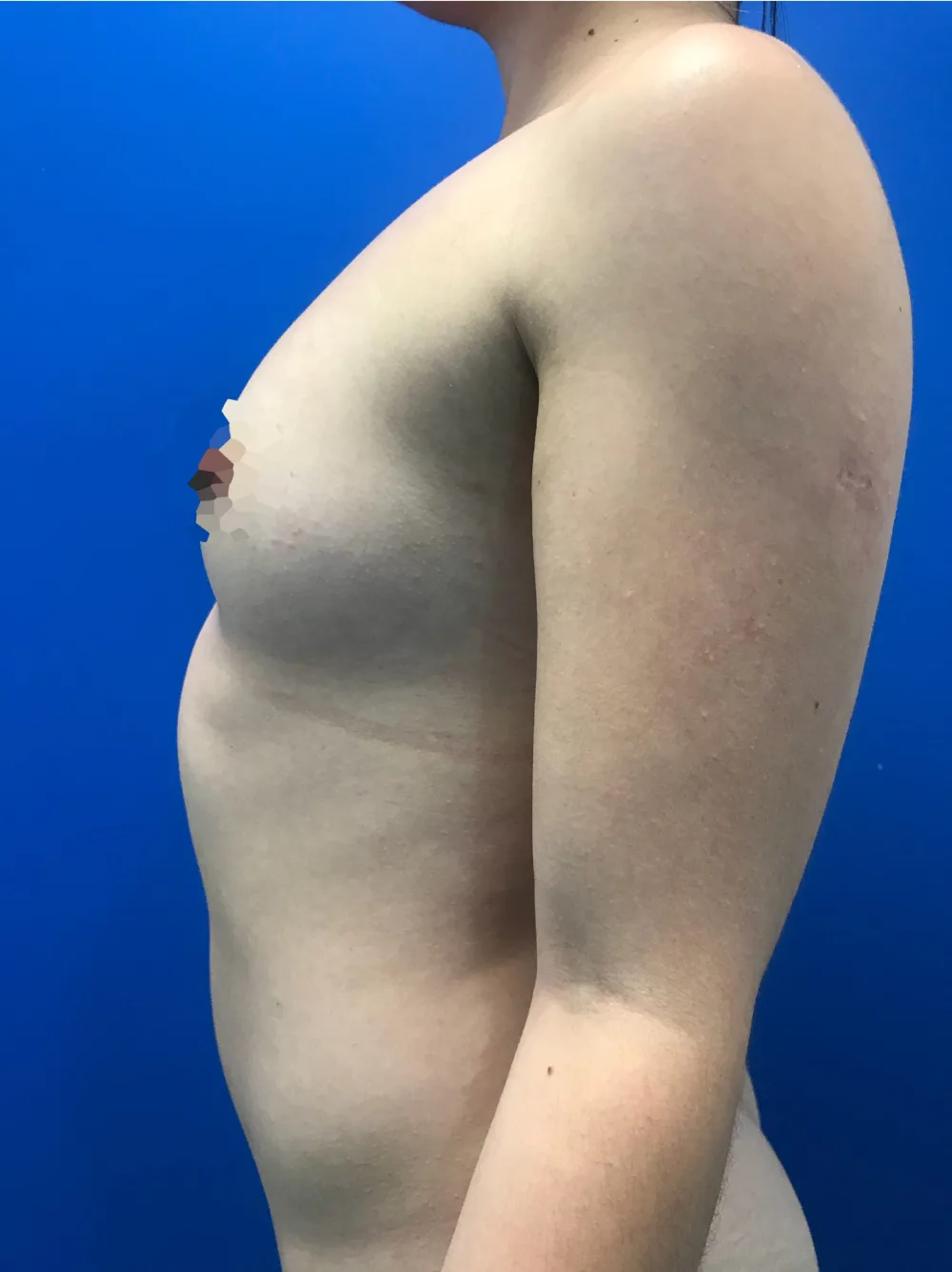 Mamoplastia de aumento en Medellín – antes, paciente del Dr. Juan David Patiño