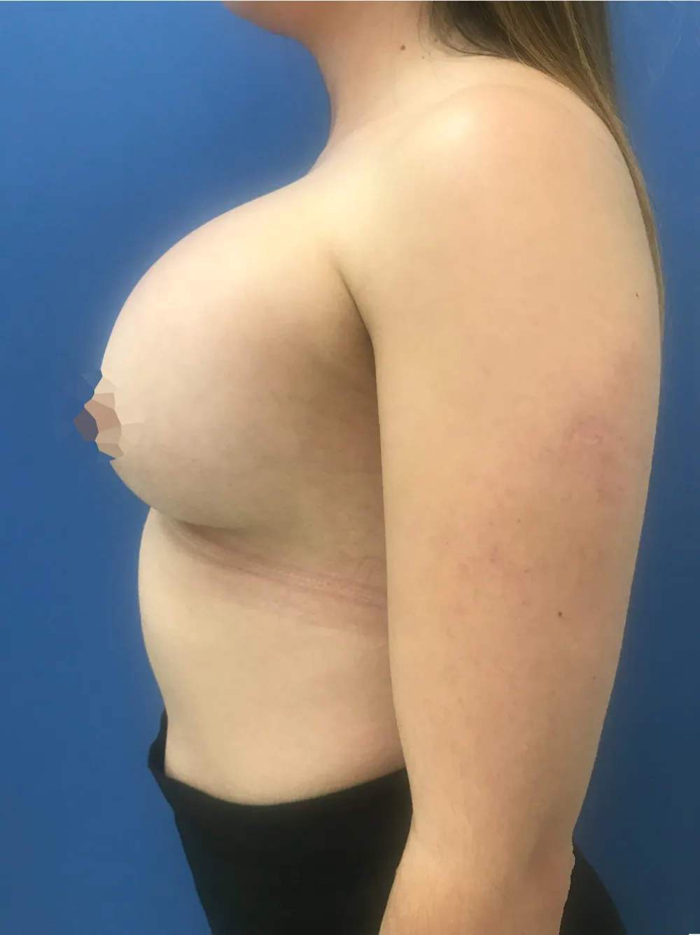 Mamoplastia de aumento en Medellín – después, paciente del Dr. Juan David Patiño