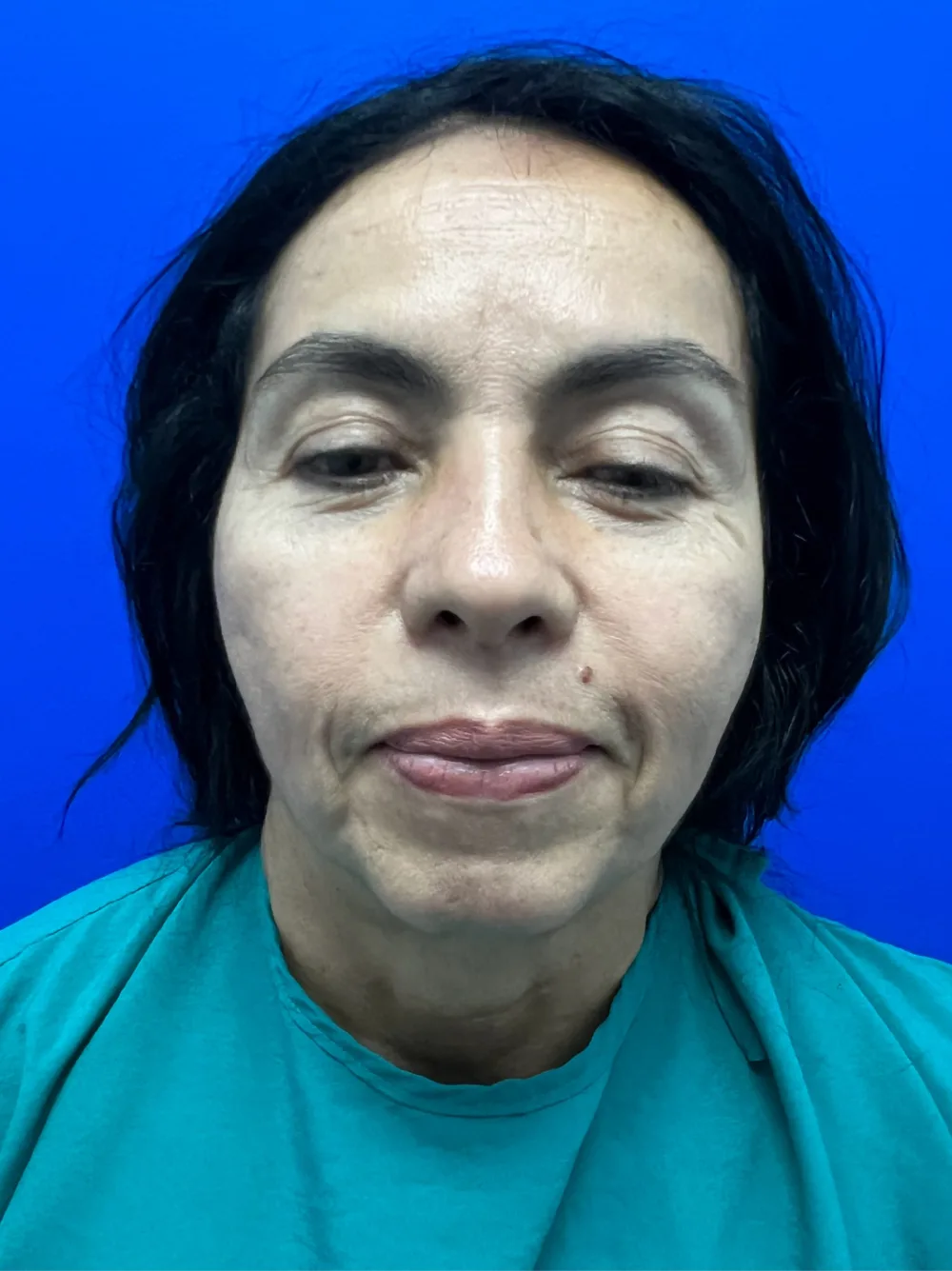 Rejuvenecimiento facial en Medellín – antes, paciente del Dr. Juan David Patiño