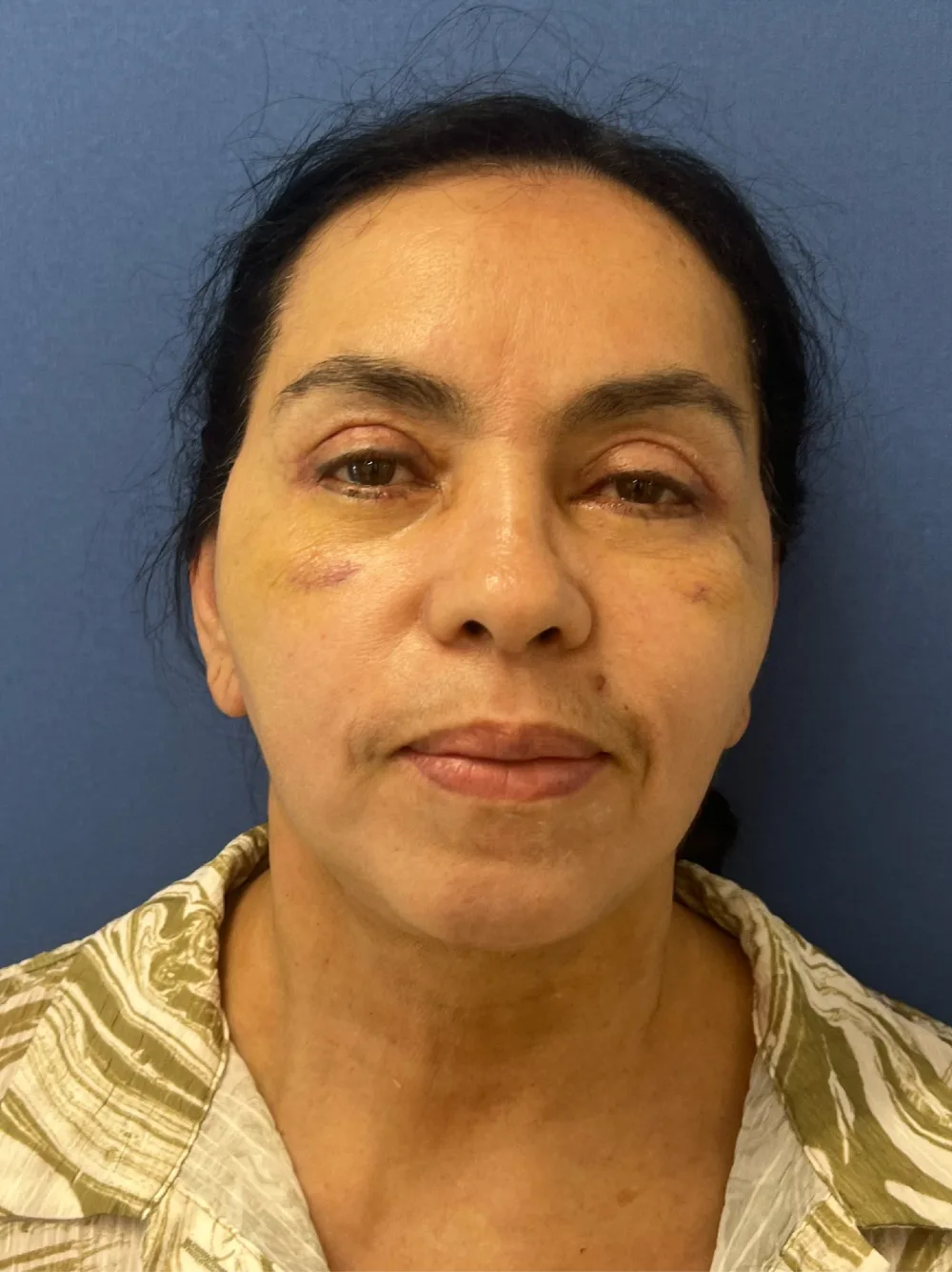 Rejuvenecimiento facial en Medellín – después, paciente del Dr. Juan David Patiño